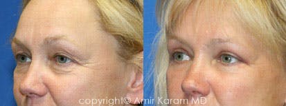 Eye Rejuvenation Before & After Gallery - Patient 71700142 - Image 1