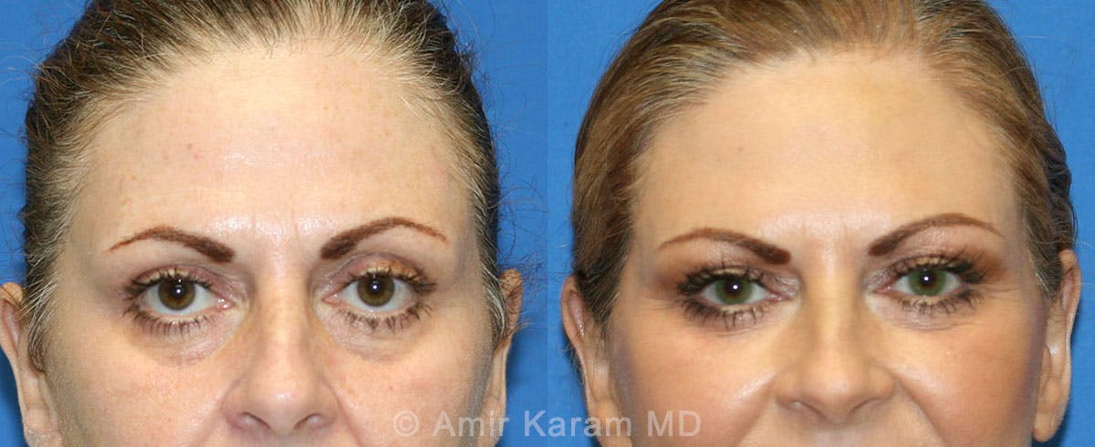 Eye Rejuvenation Before & After Gallery - Patient 71700145 - Image 1