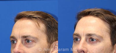 Eye Rejuvenation Before & After Gallery - Patient 71700147 - Image 1