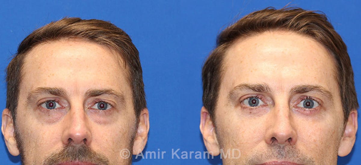 Eye Rejuvenation Before & After Gallery - Patient 71700147 - Image 2