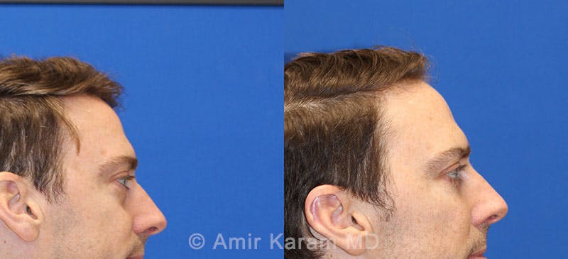 Eye Rejuvenation Before & After Gallery - Patient 71700147 - Image 3