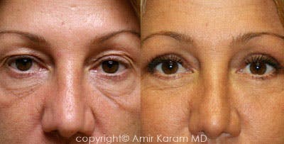 Eye Rejuvenation Before & After Gallery - Patient 71700149 - Image 1