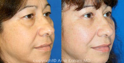 Eye Rejuvenation Before & After Gallery - Patient 71700157 - Image 1