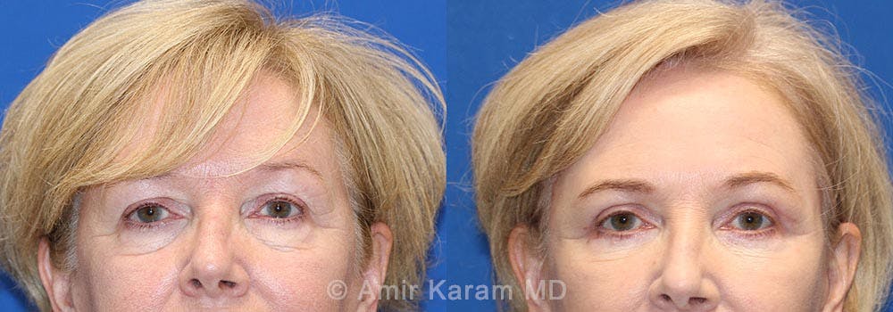 Eye Rejuvenation Before & After Gallery - Patient 71700167 - Image 1
