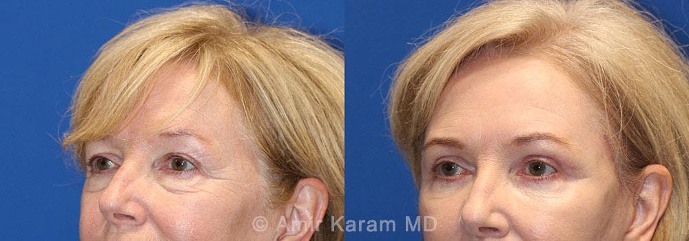Eye Rejuvenation Before & After Gallery - Patient 71700167 - Image 2