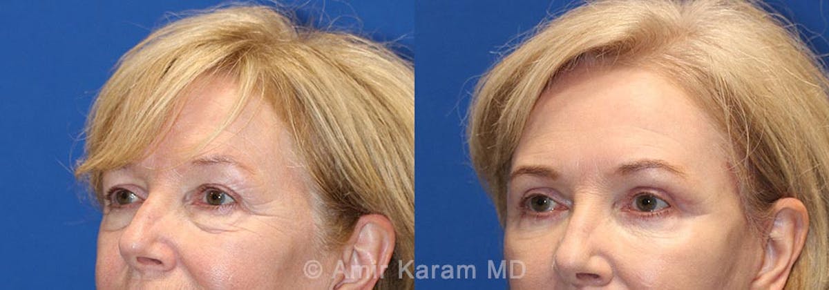 Eye Rejuvenation Before & After Gallery - Patient 71700167 - Image 2