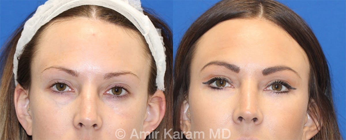 Eye Rejuvenation Before & After Gallery - Patient 71700175 - Image 1
