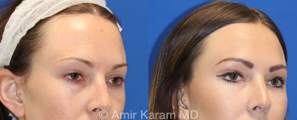 Eye Rejuvenation Before & After Gallery - Patient 71700175 - Image 2