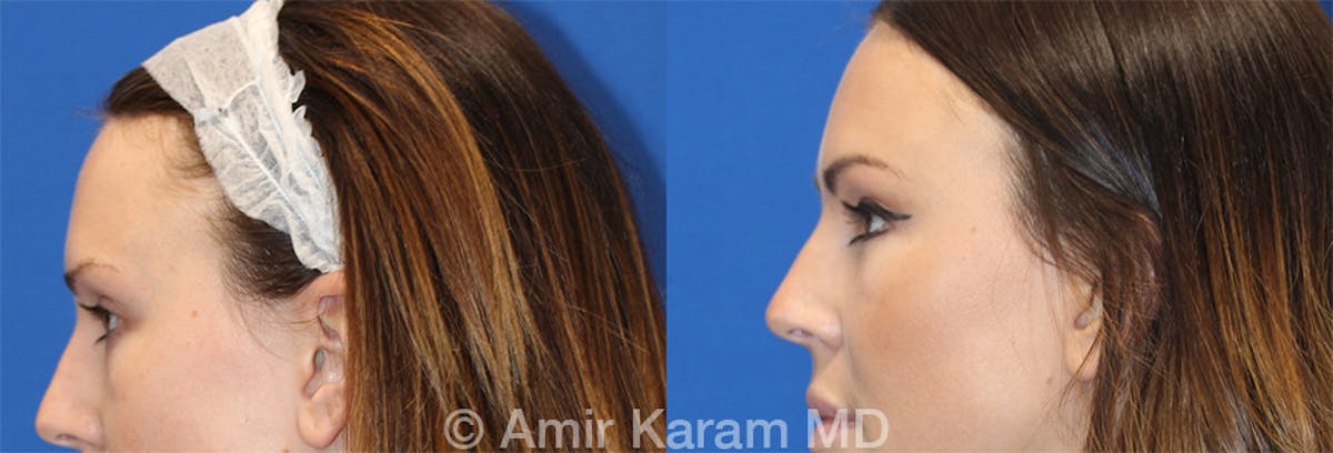 Eye Rejuvenation Before & After Gallery - Patient 71700175 - Image 3