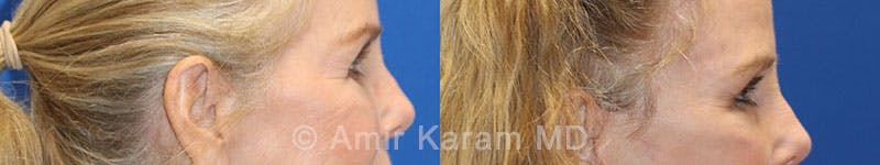 Eye Rejuvenation Before & After Gallery - Patient 71700191 - Image 5