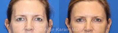 Eye Rejuvenation Before & After Gallery - Patient 71700192 - Image 1