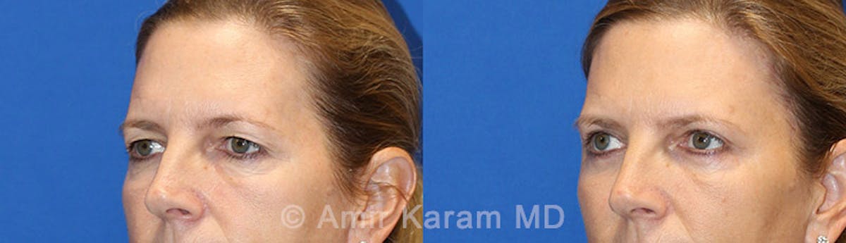 Eye Rejuvenation Before & After Gallery - Patient 71700192 - Image 2