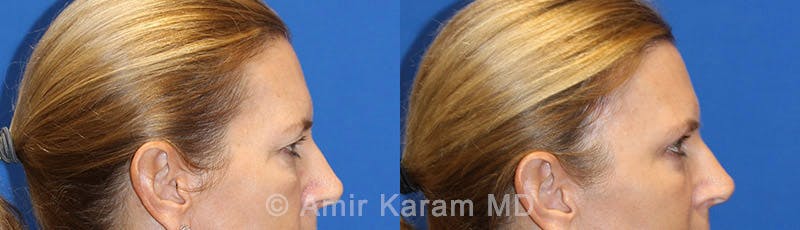 Eye Rejuvenation Before & After Gallery - Patient 71700192 - Image 3