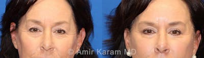 Eye Rejuvenation Before & After Gallery - Patient 71700196 - Image 1