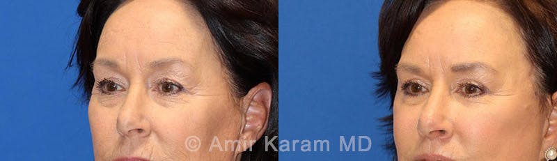 Eye Rejuvenation Before & After Gallery - Patient 71700196 - Image 2