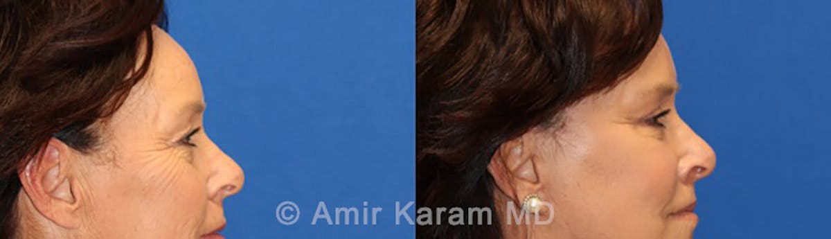 Eye Rejuvenation Before & After Gallery - Patient 71700196 - Image 3
