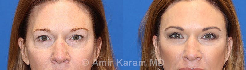 Eye Rejuvenation Before & After Gallery - Patient 71700200 - Image 1