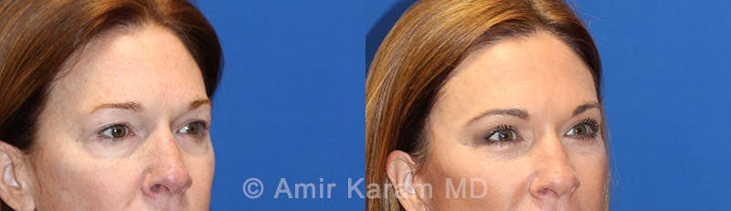 Eye Rejuvenation Before & After Gallery - Patient 71700200 - Image 2