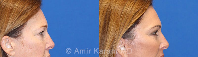Eye Rejuvenation Before & After Gallery - Patient 71700200 - Image 3