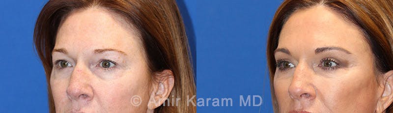 Eye Rejuvenation Before & After Gallery - Patient 71700200 - Image 4