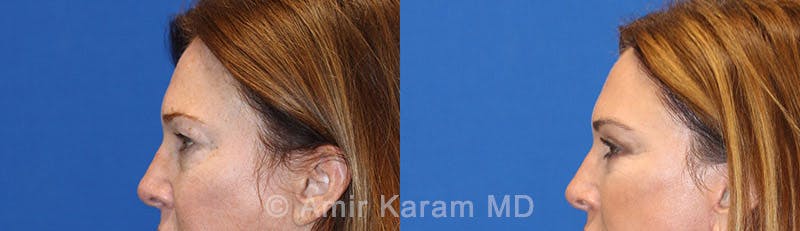 Eye Rejuvenation Before & After Gallery - Patient 71700200 - Image 5