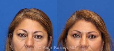 Eye Rejuvenation Before & After Gallery - Patient 71700203 - Image 1