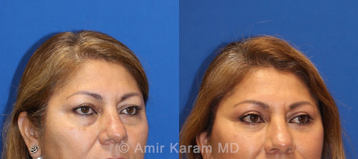 Eye Rejuvenation Before & After Gallery - Patient 71700203 - Image 2