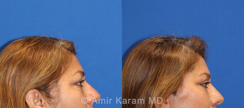 Eye Rejuvenation Before & After Gallery - Patient 71700203 - Image 3