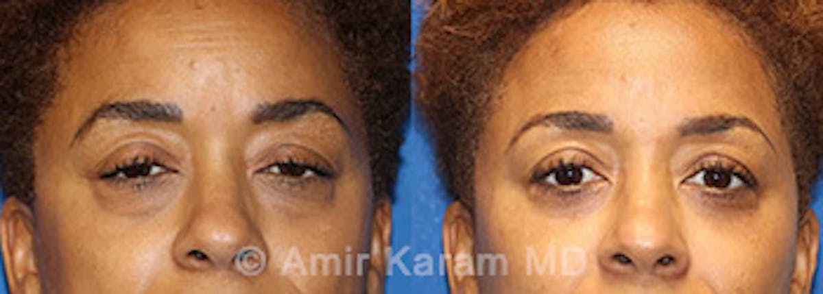 Eye Rejuvenation Before & After Gallery - Patient 71700205 - Image 1