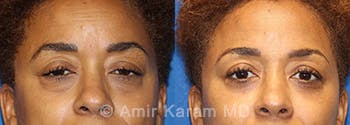 Eye Rejuvenation Before & After Gallery - Patient 71700205 - Image 1
