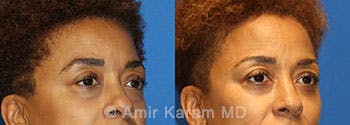 Eye Rejuvenation Before & After Gallery - Patient 71700205 - Image 2