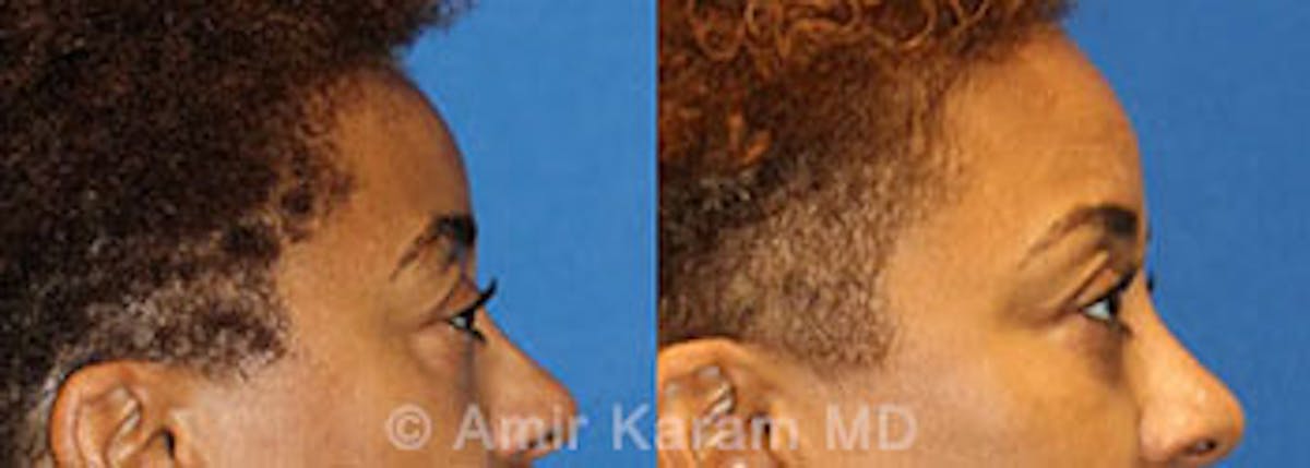 Eye Rejuvenation Before & After Gallery - Patient 71700205 - Image 3
