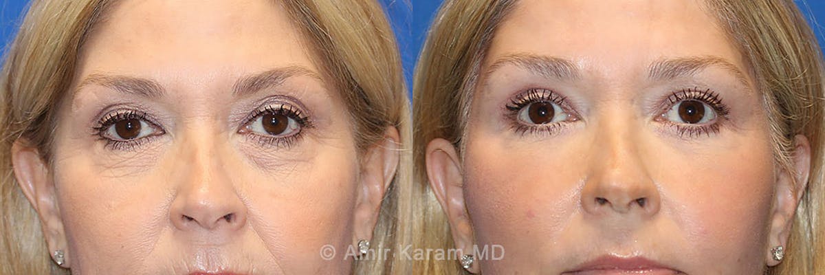 Eye Rejuvenation Before & After Gallery - Patient 71700210 - Image 1