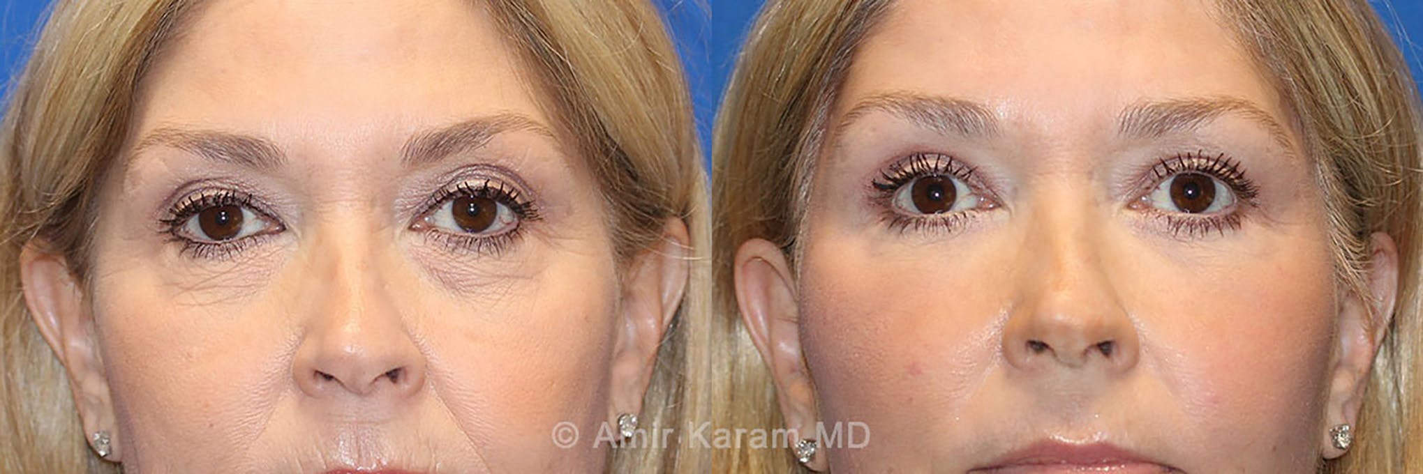 Eye Rejuvenation Before & After Gallery - Patient 71700210 - Image 1