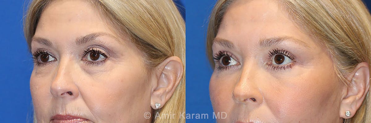 Eye Rejuvenation Before & After Gallery - Patient 71700210 - Image 2