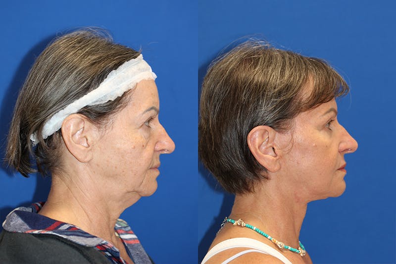 Eye Rejuvenation Before & After Gallery - Patient 71700217 - Image 2