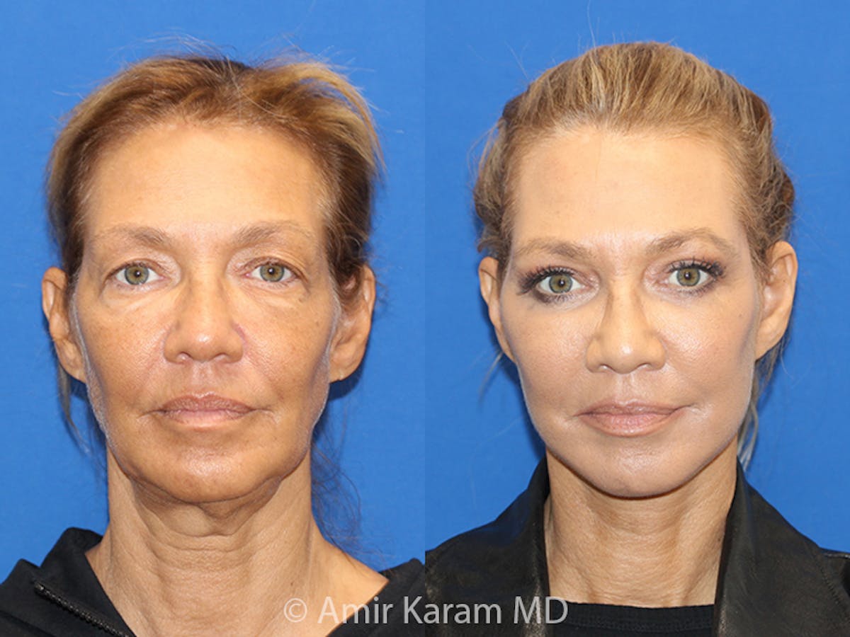 Vertical Restore® / Facial Rejuvenation Before & After Gallery - Patient 71700587 - Image 1