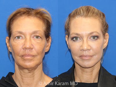 Vertical Restore® / Facial Rejuvenation Before & After Gallery - Patient 71700587 - Image 1