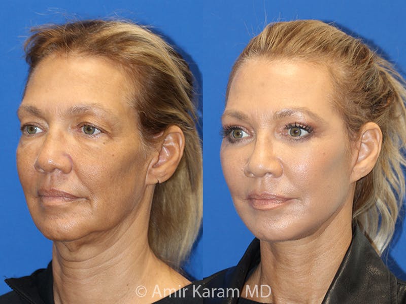 Vertical Restore® / Facial Rejuvenation Before & After Gallery - Patient 71700587 - Image 2
