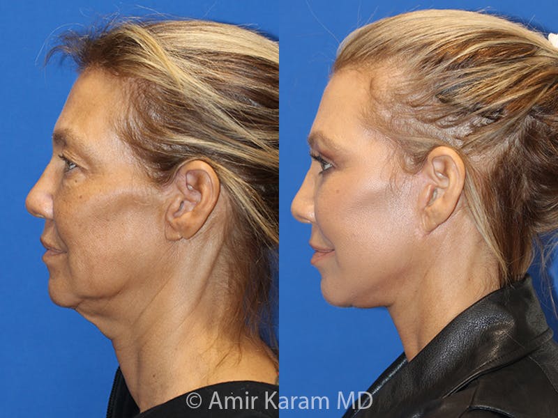 Vertical Restore® / Facial Rejuvenation Before & After Gallery - Patient 71700587 - Image 3