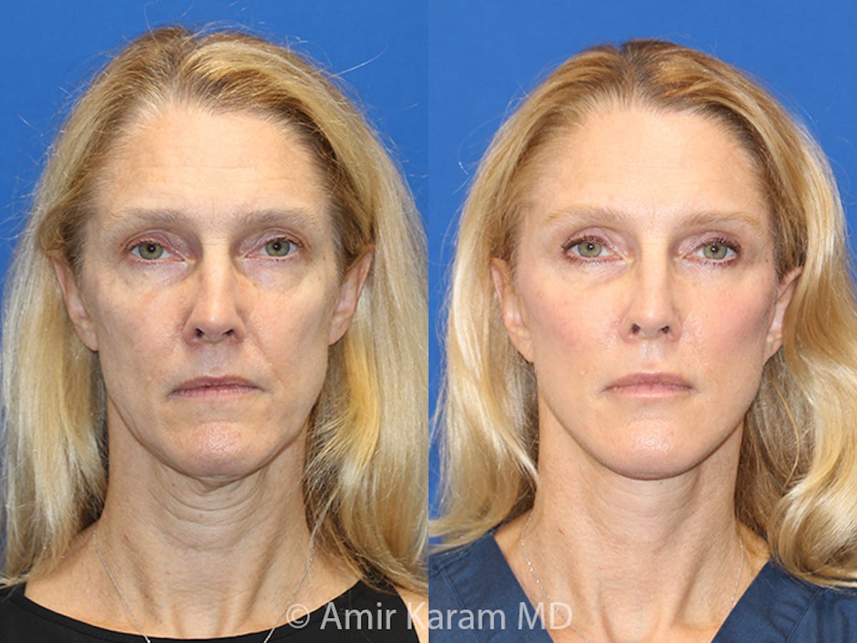 Vertical Restore® / Facial Rejuvenation Before & After Gallery - Patient 71700592 - Image 1
