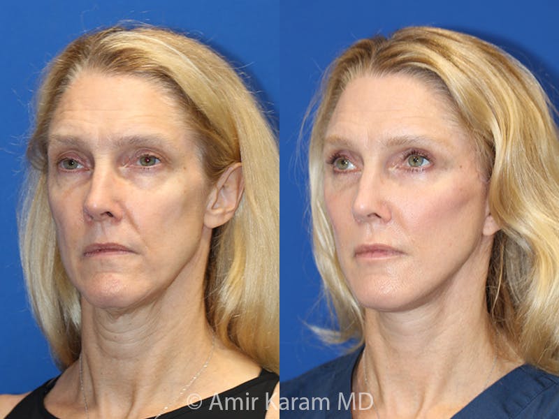 Vertical Restore® / Facial Rejuvenation Before & After Gallery - Patient 71700592 - Image 2