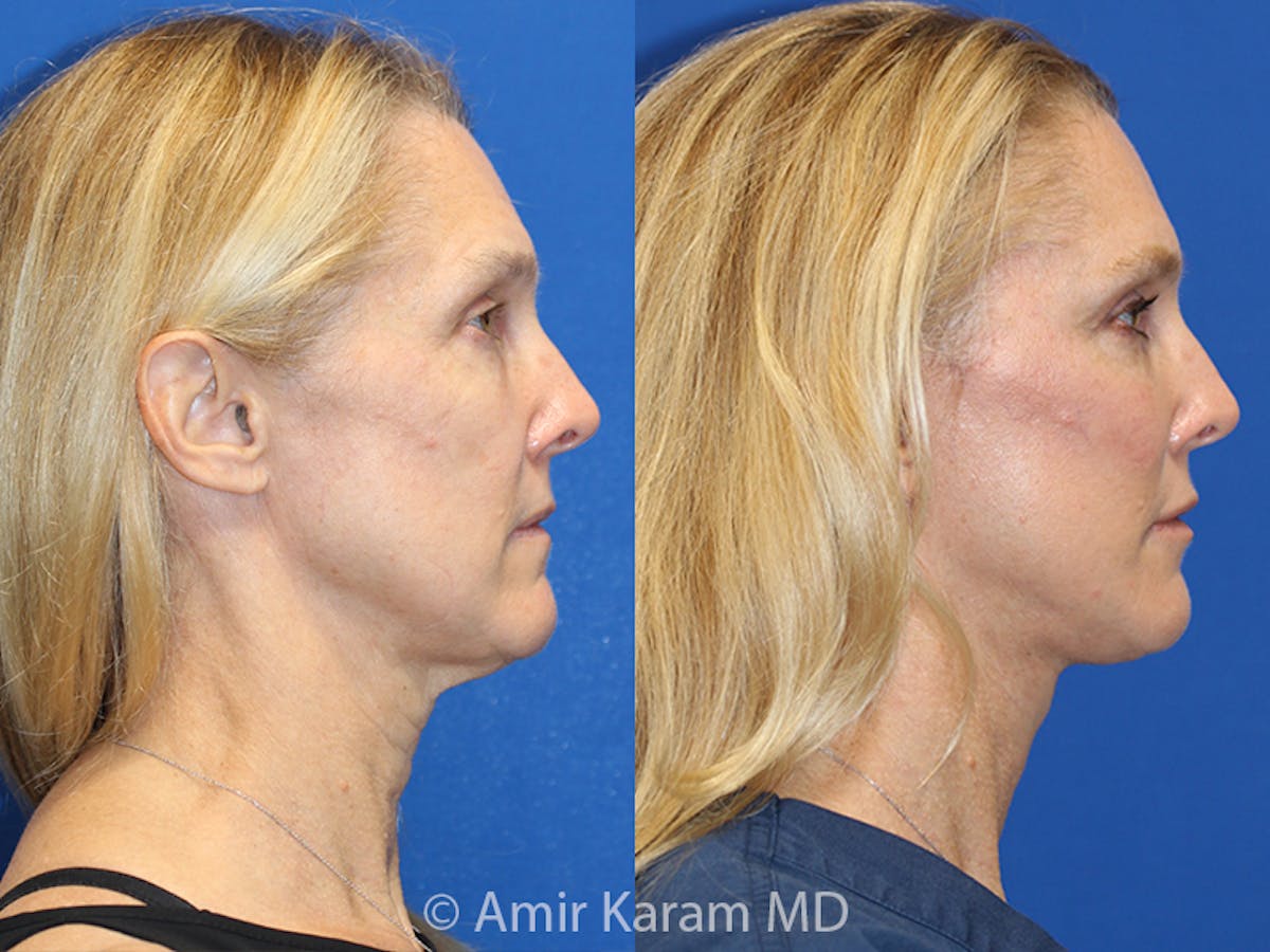 Vertical Restore® / Facial Rejuvenation Before & After Gallery - Patient 71700592 - Image 3