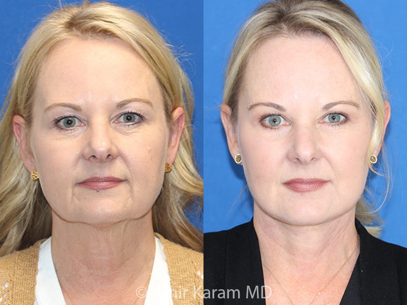 Vertical Restore® / Facial Rejuvenation Before & After Gallery - Patient 71700602 - Image 1