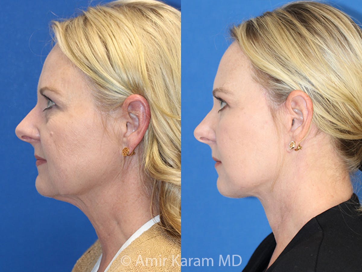 Vertical Restore® / Facial Rejuvenation Before & After Gallery - Patient 71700602 - Image 2