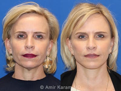 Lip Lift Before & After Gallery - Patient 83244779 - Image 1