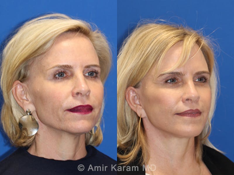 Lip Lift Before & After Gallery - Patient 83244779 - Image 2