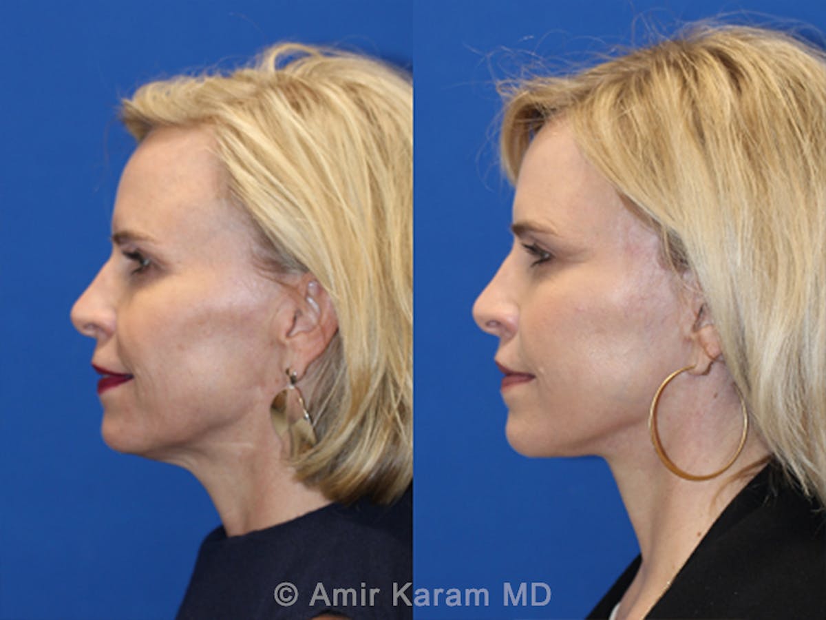 Lip Lift Before & After Gallery - Patient 83244779 - Image 3