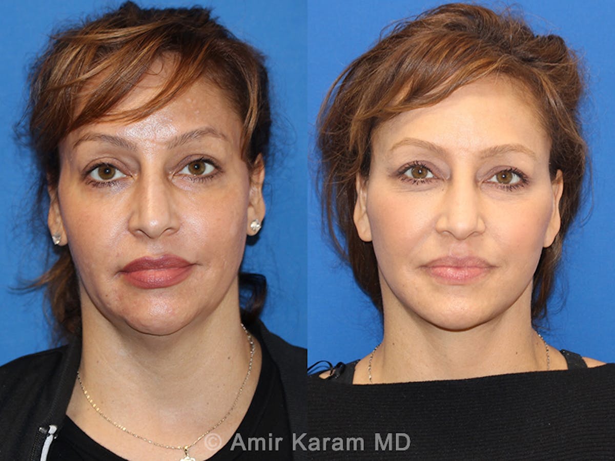 Vertical Restore® / Facial Rejuvenation Before & After Gallery - Patient 71700609 - Image 1