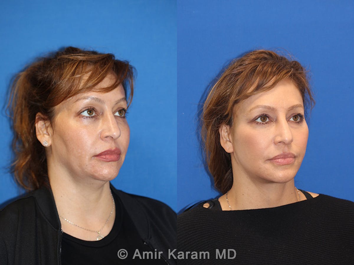Vertical Restore® / Facial Rejuvenation Before & After Gallery - Patient 71700609 - Image 2